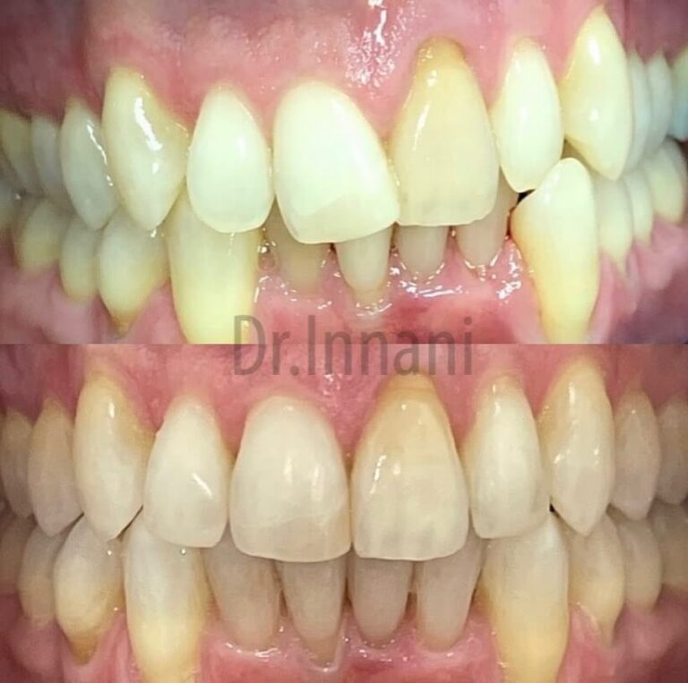Front Teeth Alignment With Invisalign Aligners