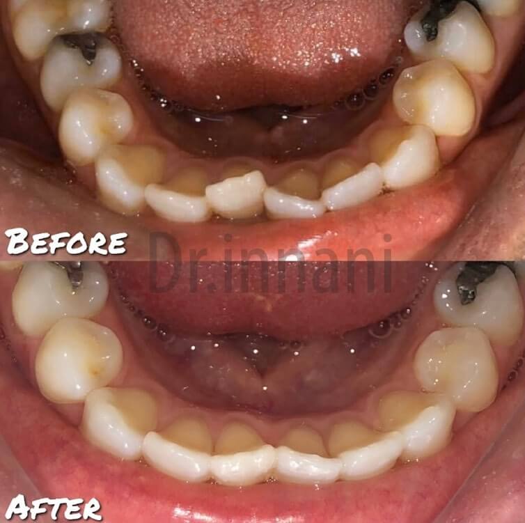 Lower Teeth Alignment Before and After Using Invisalign in East London