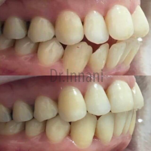 Side View of Teeth Before and After Invisalign Alignment in Romford