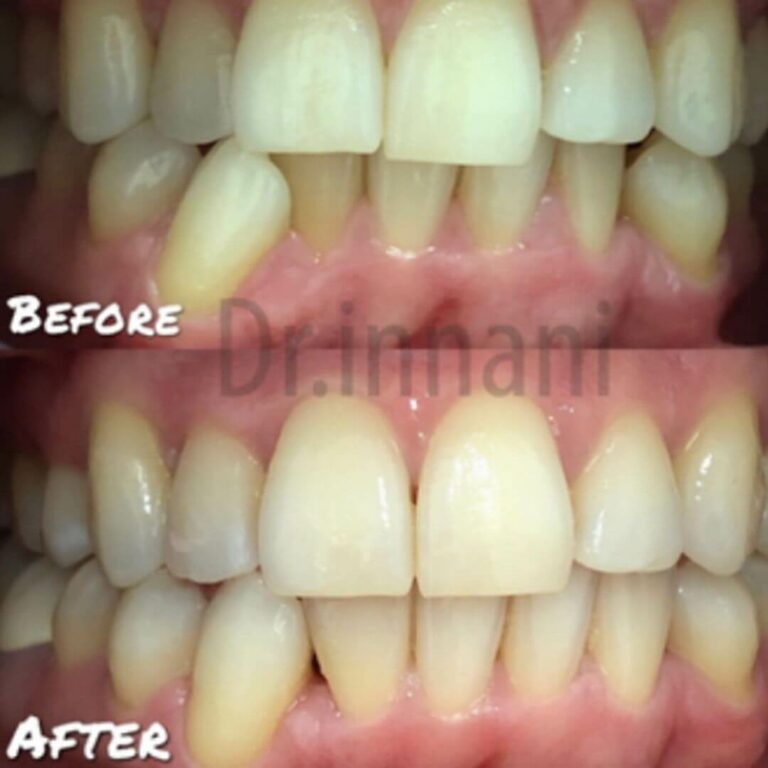 Dental Alignment Before and After Invisalign Treatment in East London