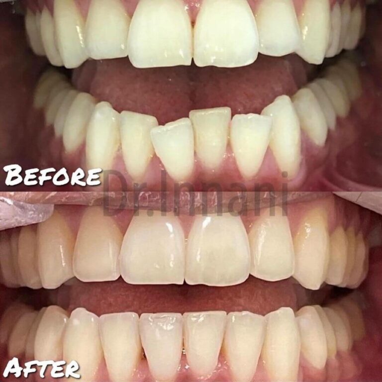 Before and After Invisalign Dental Aligner Treatment in East London